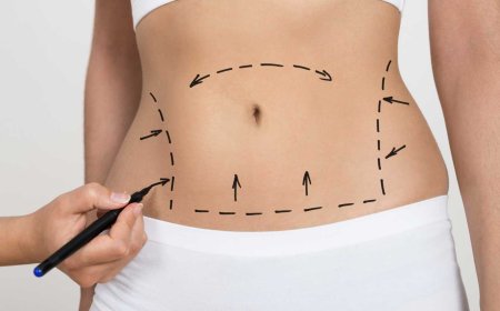 What to Expect from 360 Liposuction in Dubai: Procedure, Recovery, and Results