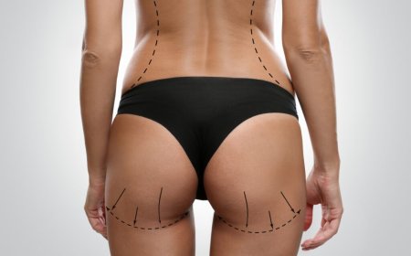 How to Choose the Best Butt Fat Transfer Surgeons in Dubai: Essential Qualities to Look For