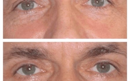 The Science Behind Eye Bags: Insights from the Best Eye Bag Removal Surgeon in Dubai