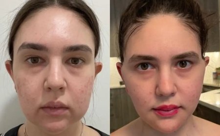 Buccal Fat Removal Recovery Timeline: What the Best Buccal Fat Removal Surgeon in Dubai Recommends