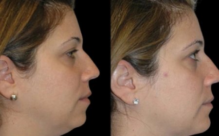 The Best Time of Year for Double Chin Removal Surgery: Tips from the Best Double Chin Removal Surgeon in Dubai
