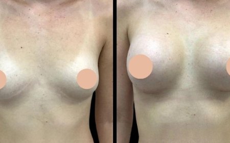 Why You Should Choose the Best Doctors in Dubai for Breast Augmentation Surgery