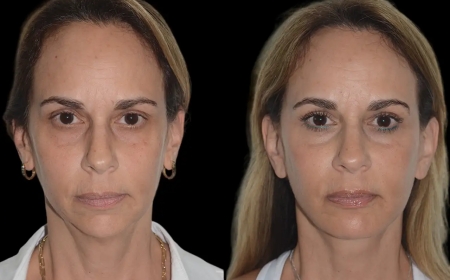 How the Best Aesthetic Clinic in Dubai for Chin Fillers Delivers Stunning Results