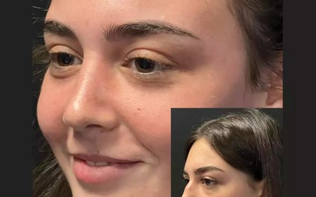 Considering Rhinoplasty in Dubai? Here’s What to Expect