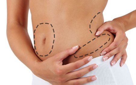 The Full Process of 360 Liposuction in Dubai: From Consultation to Recovery
