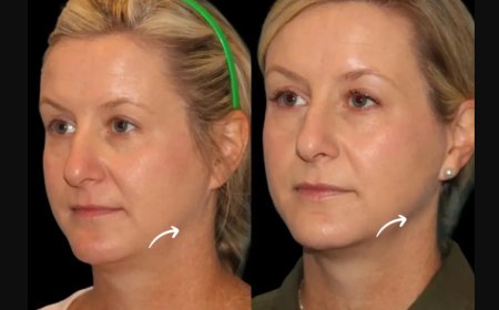 Why Sculptra Fillers in Dubai Are Popular Among Influencers