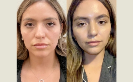 Thread Lift Treatments in Dubai: A Non-Surgical Solution for Lifting and Firming