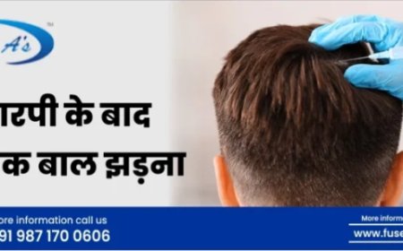PRP Ke Baad Adhik Baal Jhadna | Best Hair Transplant in Delhi